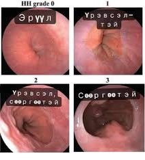 Өглөөний мэнд~😇Цээж гашуу оргино гдг нь: Ходоод гэдэсний үйл ажиллагаатай холбоотой. Ерөнхийдөө ходоодны хүчил ихсэхээр улаан хоолой орж Ингэснээр улаан хоолойн салст гэмтэж цээж гашуун оргидог. Зүй бус хооллолт, таргалалттай холбоотой. 35дээш насанд жилдээ 1 удаа дурандуулаарай