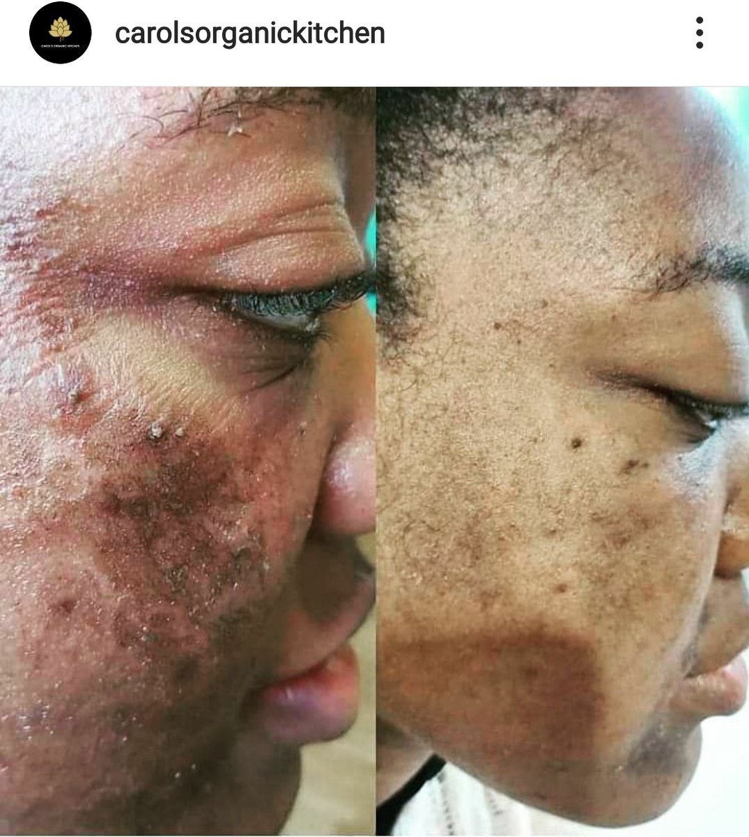 Treat eczema naturally with Dermazeam Skin Renewing Cream. You can shop with confidence with our 60 Day Money Back Gurantee. Find out what our customers are saying  shop.carolsorganickitchen.com/product/dermaz… #eczema #atopicdermatitis