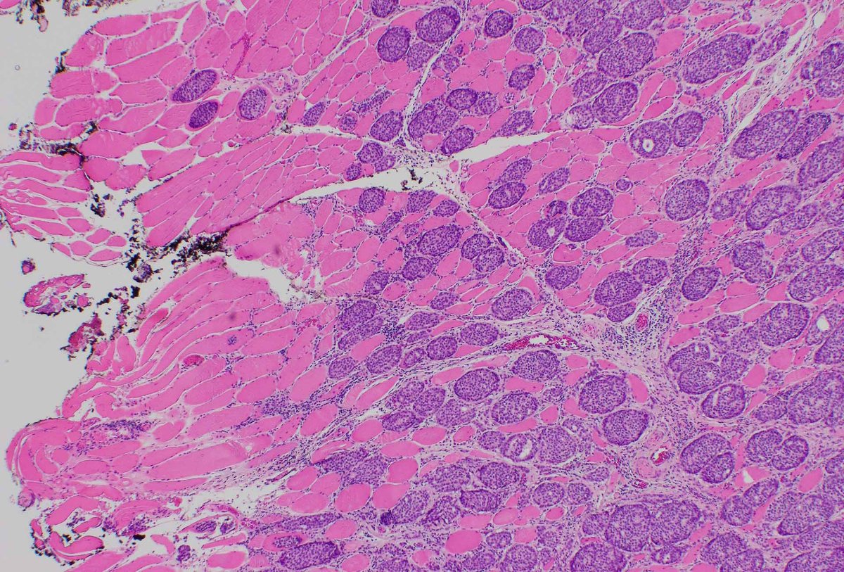 brstpathology's tweet photo. Histologically beautiful yet horrifying at the same time.  Breast cancer invading skeletal muscle https://t.co/V9DlHgjDdL