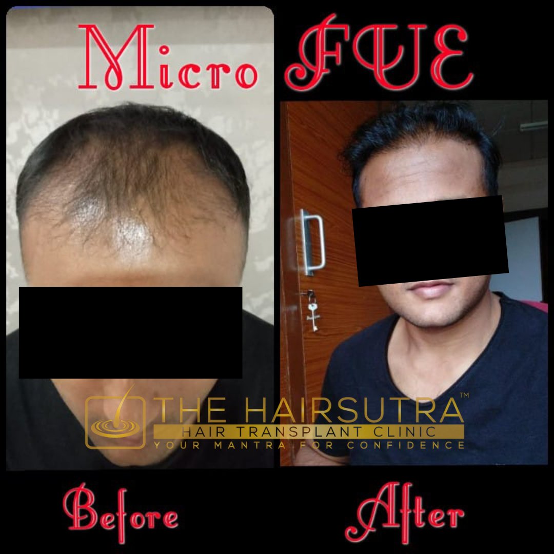 Hair Transplant In Mangalore  Best Cost Results  Surgeon Of Hair  Transplant In Mangalore  YouTube