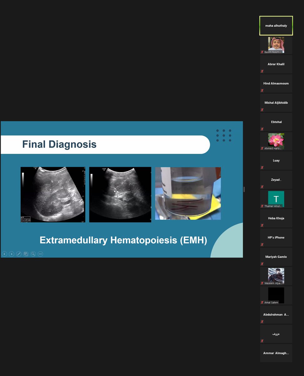 NshRadiology's tweet photo. Nice #CasePresentation by our Intern Dr. Maha Al-Huthali from UQU #Medical #Faculty about #Extramedullary #Hematopoiesis. US-guided Splenic #Biopsy was performed. #Makkah #Radiology #Residency #IRad #InterventionalRadiology #Intervention #VIR #MedicalEducation #Education https://t.co/dk2qGkcWDV