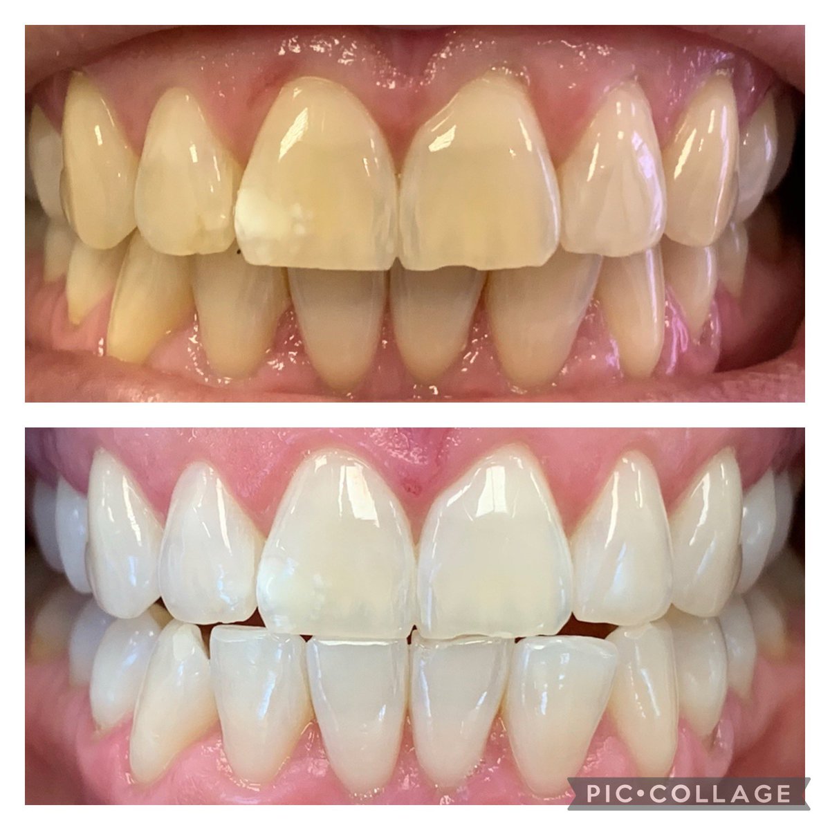 This beautiful Zoom whitening result was created by the take home whitening only! 

Our patient bleached her teeth daily for 30 minutes over a period of 24 days using the Day White 9.5% and was so over the moon to see the difference!