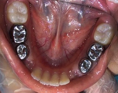 Rahaf_Najjar's tweet image. علاج الاسنان تحت التخدير الكامل
احيان يقترح طبيب الاسنان علاج الطفل تحت التخدير الكامل ، و كثير من الاهالي يتسائلو: هل علاج الاسنان تحت التخدير الكامل امن لطفلي؟ و ايش بيصير لما يتنوم الطفل عشان علاج اسنانه؟