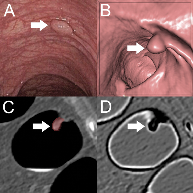 _System_X_'s tweet image. "Selon une étude publiée dans la revue Radiology, un #algorithme de deep learning permet de différencier avec précision les polypes colorectaux bénins et prémalins sur les coloscopies virtuelles par #scanner." - Thema Radiology

En savoir plus ⏩ bit.ly/3pX1pHA