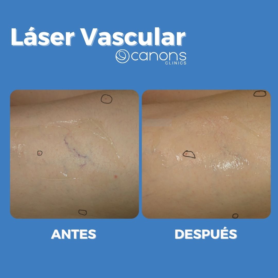 canonsclinics's tweet photo. Increíbles cambios con tan solo UNA SESIÓN de LÁSER VASCULAR 😍 #excelhr #laservascular #cutera https://t.co/9TaM2YYKGi