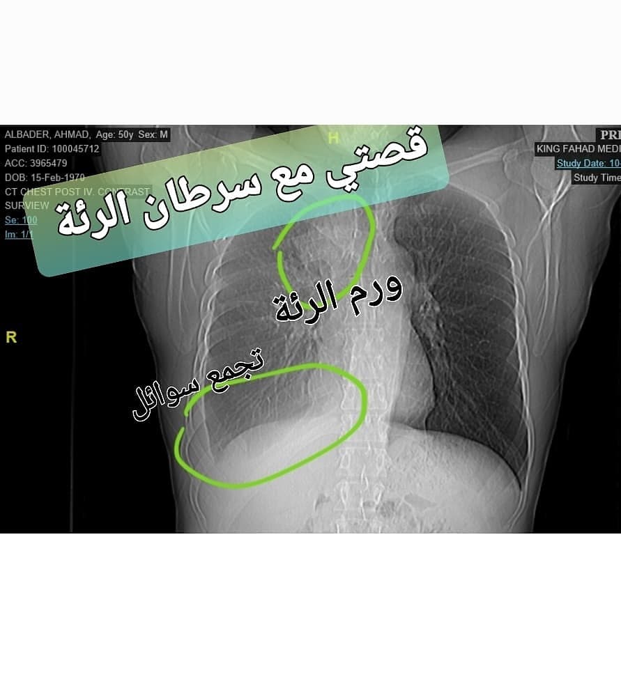 قصتي مع سرطان الرئة...

في شهر ديسمبر 2020 بدأت أشعر بضيق النفس، و اخذ في الازدياد. بعد تحاليل و علاجات أولية اعتقاد انه ربو، تبين انه يوجد ورم في الرئة و بعد أخذ العينة، و من ثم أخرى للتأكيد، تبين انه سرطان الرئة و قد وصل إلى المخ في عدة أماكن، اي من المرحلة الرابعة. 👇🏼