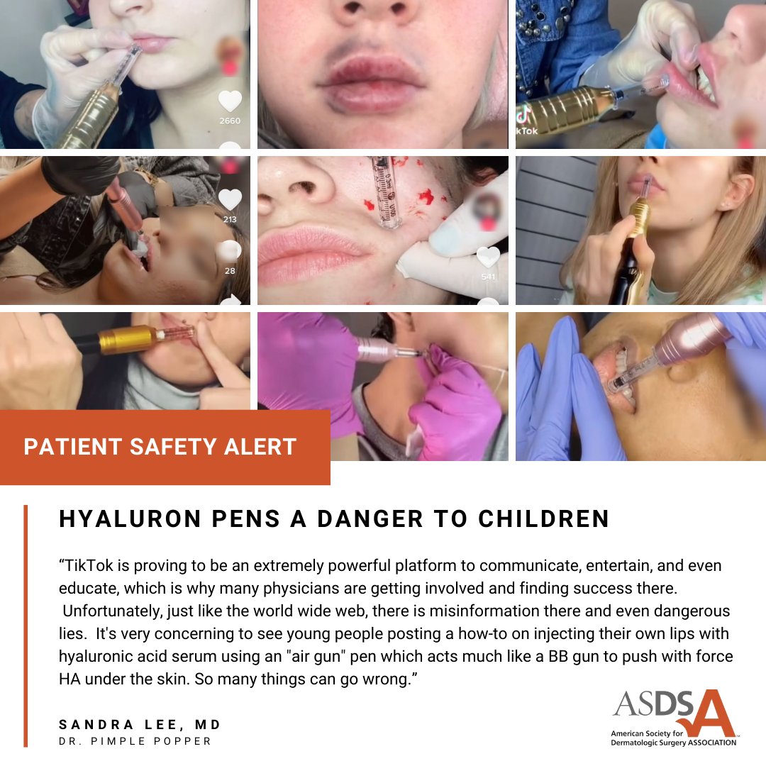 ASDSSkinMD's tweet photo. Patient Safety Alert – Disturbing social media videos show children using hyaluron pens to inject hyaluronic acid into lips, neck and face. When considering a cosmetic procedure such as dermal fillers, consult the TRUE skin and health experts — board certified dermatologists. https://t.co/xzl0aYQIky