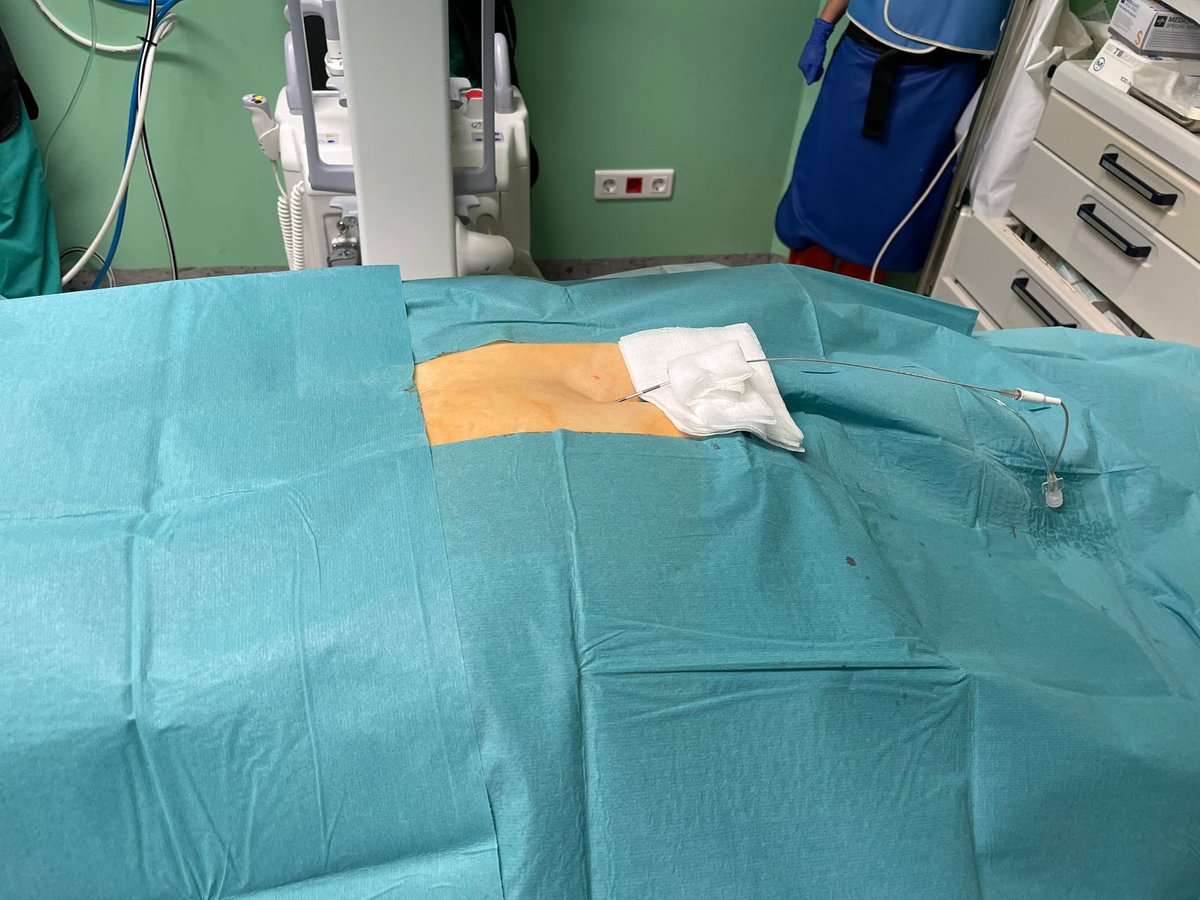 DraCBatet's tweet photo. Tratamiento en la @UnidaddeDolor del HU @SonLlatzer mediante “Epidurolisis” por #PRF en paciente con #Columna intervenida que presenta #dolorradicular L5 D. Las adherencias condicionan la dirección del catéter. @ANR_HSLL @COMbalears #semdor  @SocBalDol https://t.co/eqQxJUilvb