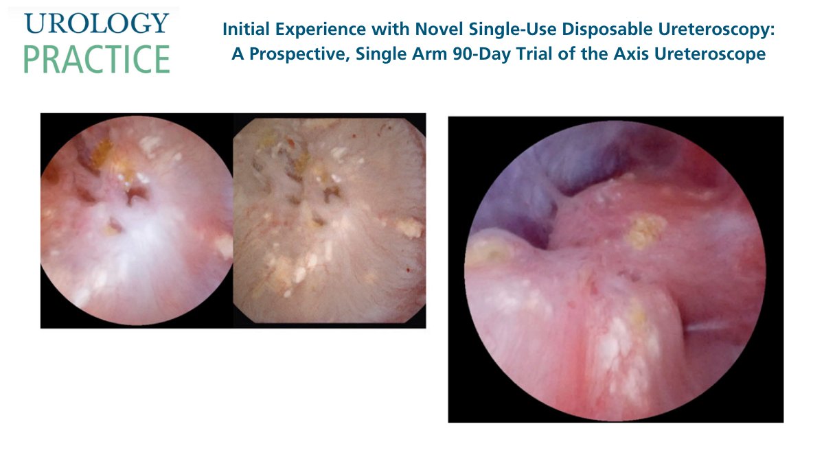 Urology Practice (@urologypractice) on Twitter photo Featured Article from the March issue of Urology Practice:
Initial Experience with Novel Single-Use Disposable Ureteroscopy: A Prospective, Single Arm 90-Day Trial of the Axis Ureteroscope bit.ly/3jTzXZ0 <a href="/amy_krambeck/">Amy Krambeck</a> Featured Article from the March issue of Urology Practice:
Initial Experience with Novel Single-Use Disposable Ureteroscopy: A Prospective, Single Arm 90-Day Trial of the Axis Ureteroscope bit.ly/3jTzXZ0 <a href="/amy_krambeck/">Amy Krambeck</a>