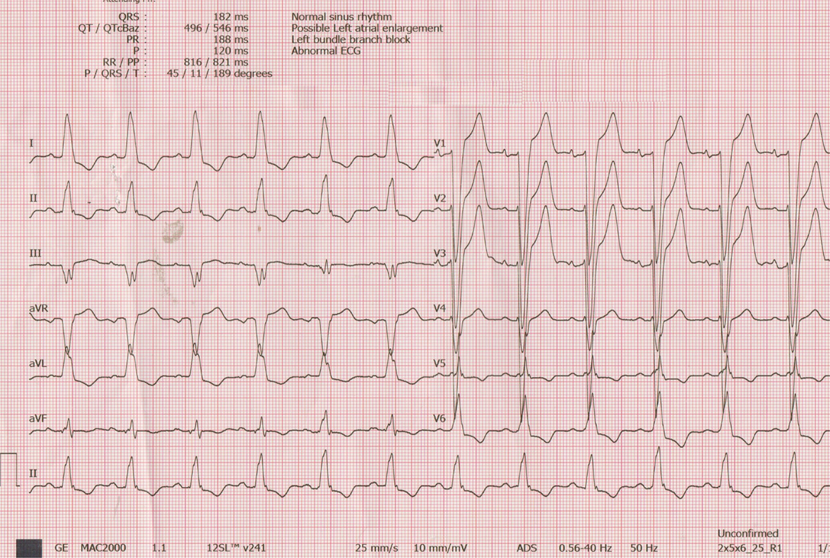 Circulation (@circaha) on Twitter photo #ECGChallenge: When You Hear Hoofbeats, Look for Horses🐴, Not Zebras🦓!ow.ly/izcl50DHNoc #AHAJournals <a href="/drtopaloglu/">Prof. Dr. Serkan Topaloğlu</a> <a href="/DursunAras2/">Dursun Aras, Professor</a> <a href="/ozcanozeke/">Özcan Özeke</a> #ECGChallenge: When You Hear Hoofbeats, Look for Horses🐴, Not Zebras🦓!ow.ly/izcl50DHNoc #AHAJournals <a href="/drtopaloglu/">Prof. Dr. Serkan Topaloğlu</a> <a href="/DursunAras2/">Dursun Aras, Professor</a> <a href="/ozcanozeke/">Özcan Özeke</a>