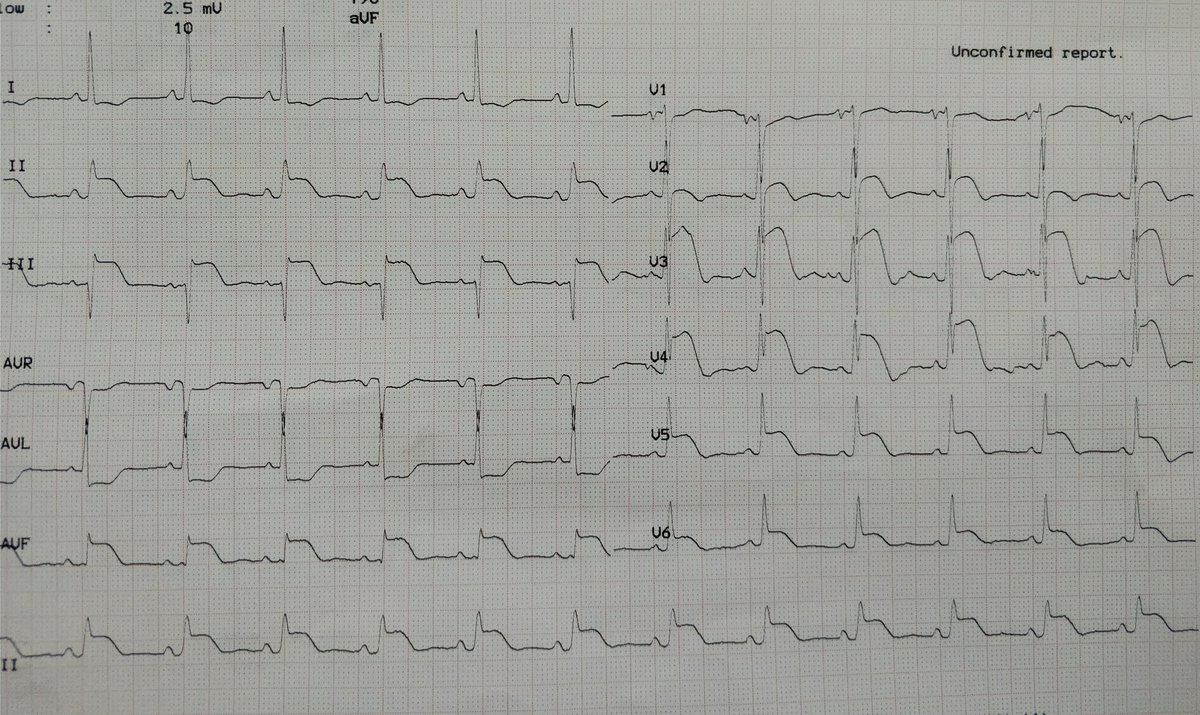 55/female presented with chest pain , troponin awaited, primary PCI capable hospital ( story will continue with some twist)
1) OMI or not
2) activate cath or not??
3)" Where is the culprit "?#cardiotwitter <a href="/brun_dav/">David Brun</a> <a href="/smithECGBlog/">Stephen W. Smith</a> <a href="/ecgrhythms/">Arnel Carmona</a> <a href="/EM_RESUS/">Sam Ghali, M.D.</a> <a href="/BrooksWalsh/">Brooks Walsh</a>
