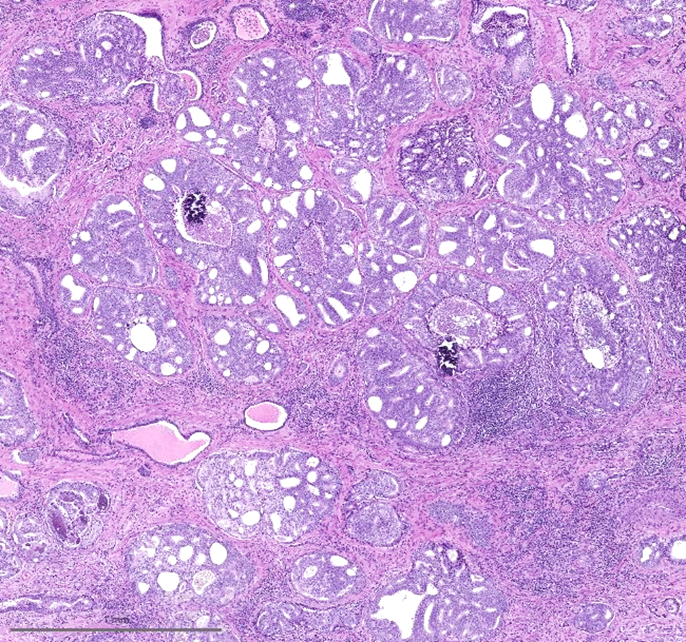 rovingatuscap's tweet photo. Cribriform architecture is sieve-like (mass of cells with multiple spaces) and may be seen in:

Invasive Gleason pattern 4 disease: https://t.co/LS5jjKQa6A

or in

Intraductal carcinoma (surrounded by basal cells): https://t.co/RNpfZobd4v  #prostateJC #gupath https://t.co/wYovWSVpQg