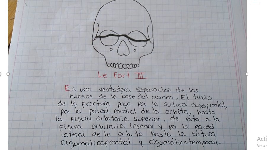 MariaGu93319668's tweet photo. Cirugía Bucal I
FRACTURAS MANDIBULARES Y MAXILARES
@MariselaPonce7 https://t.co/Ynwuq8YcMC