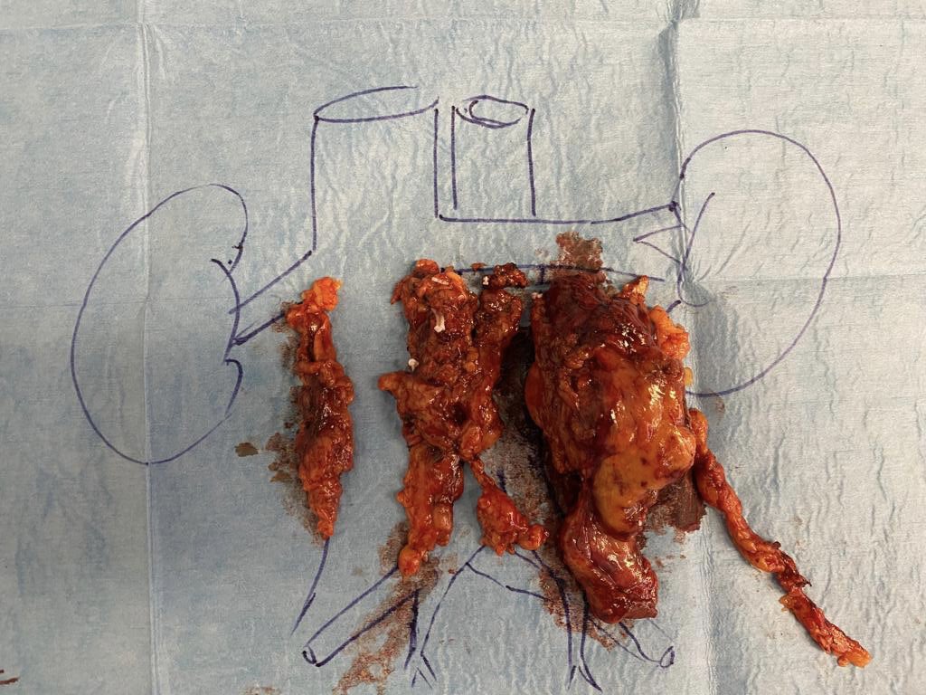 GregAssenmacher's tweet photo. Very pleased with the James Porter technique for supine RA-RPLND.
Today 5th case @europehospitals in Brussels. 39y, post-chemo TGNS, 6cm residual mass para-Ao, s0. Tks @LoosShirley and @GiovanniTasso1 for assist. @JamesPorterMD @BertrandTOMBAL @ThRoumeguere @eau_yuo https://t.co/d3bkFG5gqv