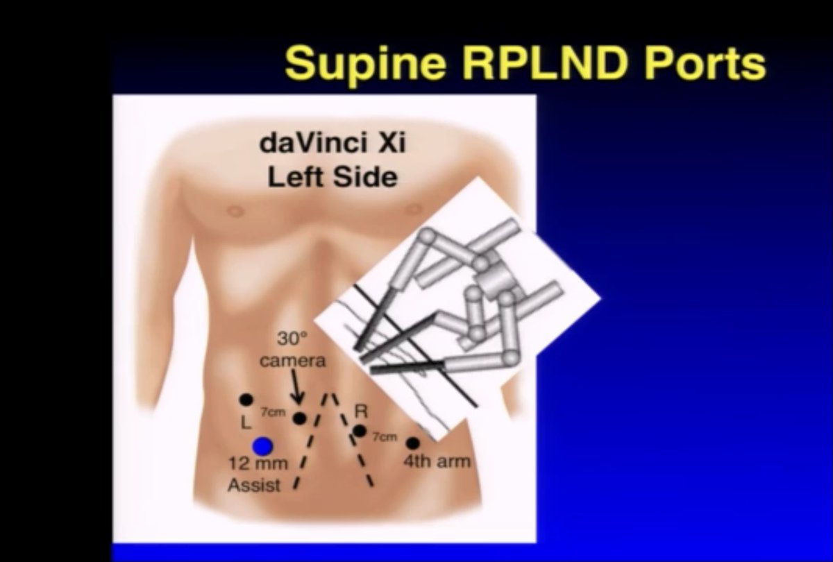 GregAssenmacher's tweet photo. Very pleased with the James Porter technique for supine RA-RPLND.
Today 5th case @europehospitals in Brussels. 39y, post-chemo TGNS, 6cm residual mass para-Ao, s0. Tks @LoosShirley and @GiovanniTasso1 for assist. @JamesPorterMD @BertrandTOMBAL @ThRoumeguere @eau_yuo https://t.co/d3bkFG5gqv