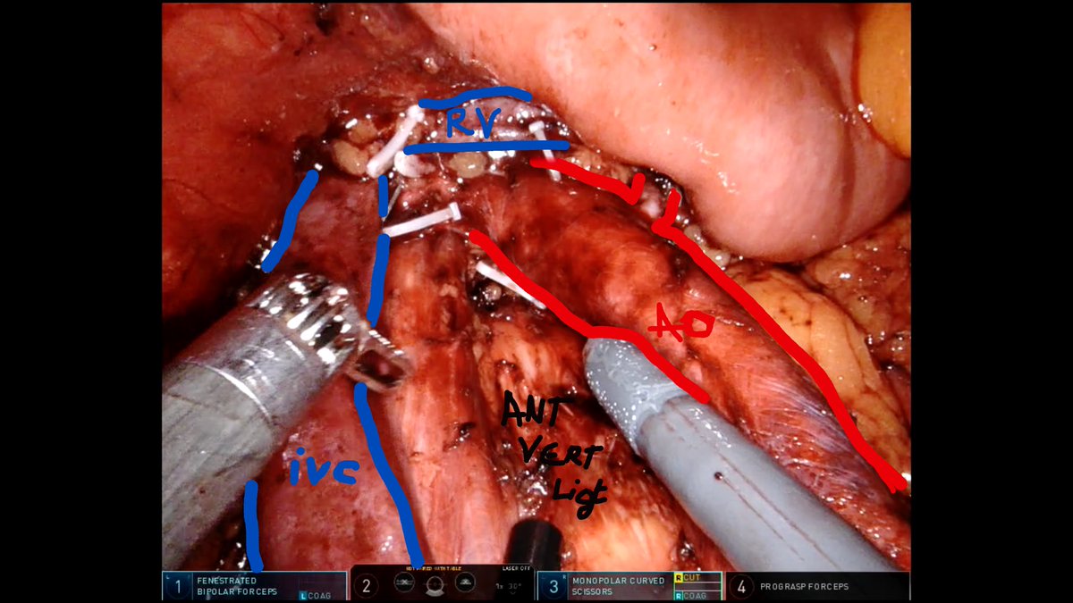 GregAssenmacher's tweet photo. Very pleased with the James Porter technique for supine RA-RPLND.
Today 5th case @europehospitals in Brussels. 39y, post-chemo TGNS, 6cm residual mass para-Ao, s0. Tks @LoosShirley and @GiovanniTasso1 for assist. @JamesPorterMD @BertrandTOMBAL @ThRoumeguere @eau_yuo https://t.co/d3bkFG5gqv