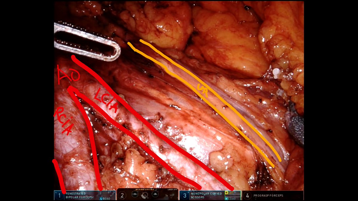 GregAssenmacher's tweet photo. Very pleased with the James Porter technique for supine RA-RPLND.
Today 5th case @europehospitals in Brussels. 39y, post-chemo TGNS, 6cm residual mass para-Ao, s0. Tks @LoosShirley and @GiovanniTasso1 for assist. @JamesPorterMD @BertrandTOMBAL @ThRoumeguere @eau_yuo https://t.co/d3bkFG5gqv