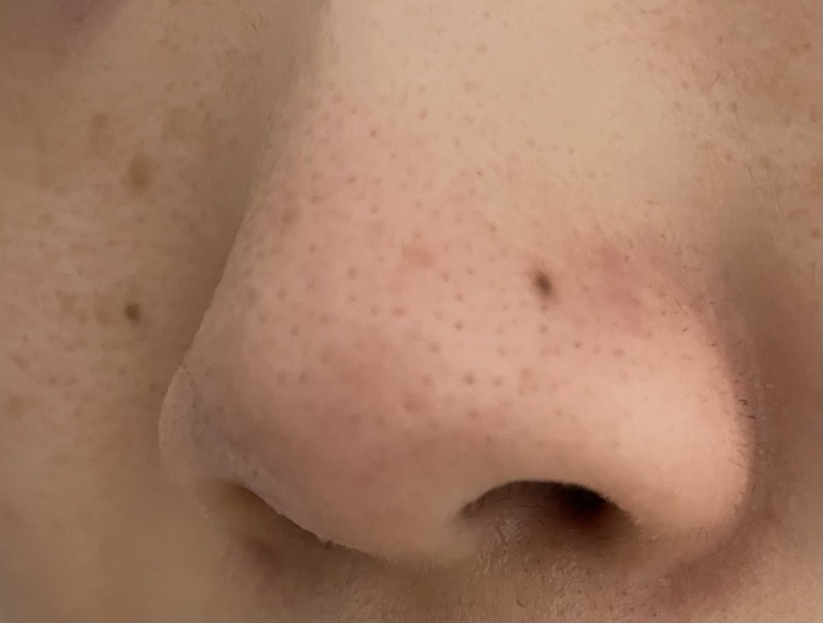 店員 島暮らししてます ピギーノーズ初めて使ったけど ホンマに取れる 写真4枚目が3ステップ後 毛穴がまだぽっかり開いてる感じがしたのでもう少し保湿パックしました 写真3枚目閲覧注意 ピギーノーズ 韓国コスメ 毛穴 角栓