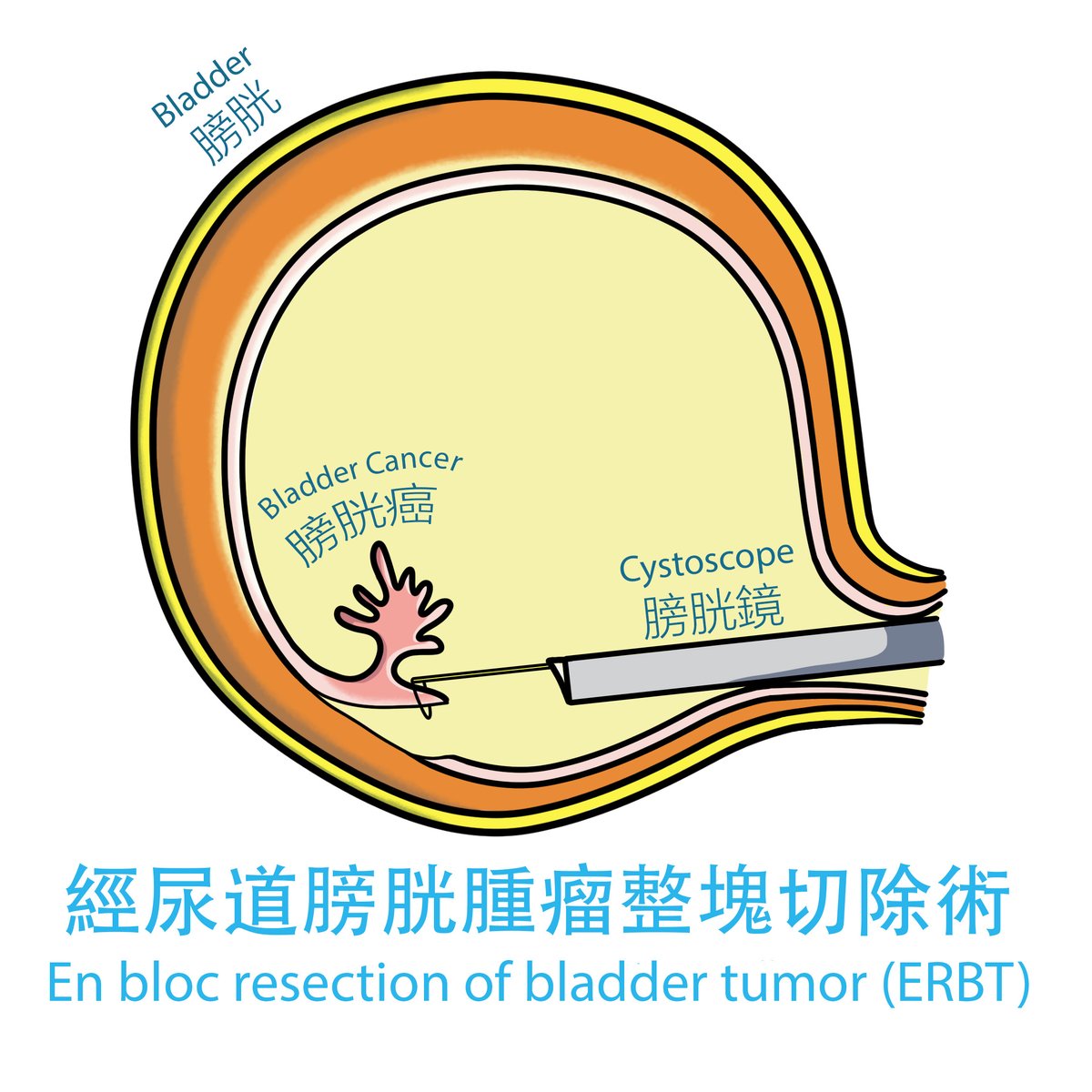 Some patients of bladder cancer may require surgical treatment. ERBT is a novel surgery in treating bladder cancer: bit.ly/2ODwTWb

#CUHKUrology has recently developed consensus statements📋 on ERBT: bit.ly/3jZPDe8