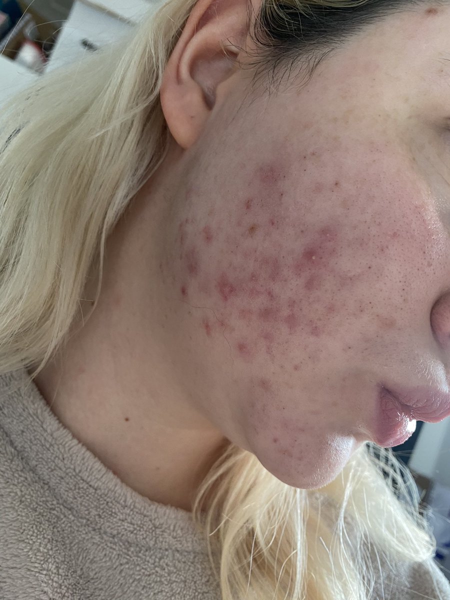 xchelsbxo's tweet photo. This is going to be a thread, if you’re thinking of using CERAVE skin care please don’t! I had the biggest reaction  after buying them from the store on Amazon. I believe they must have switched the products and given me fake stuff! I contacted them and it took two weeks for a.. https://t.co/jXa4cOCbkS