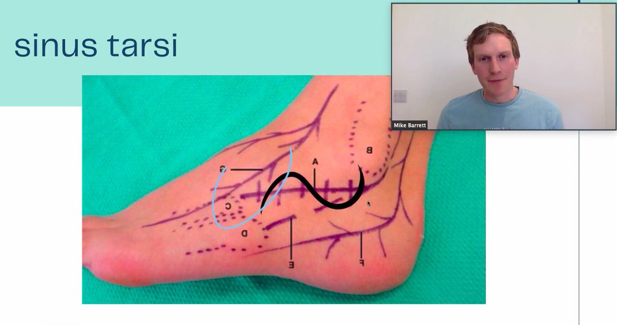 Mr Mike Barrett talking about the Sinus Tarsi approach for calcaneal fractures. Cambridge Orthopaedics Lower Limb Trauma Course <a href="/mikebarrett647/">Mike Barrett</a> <a href="/CambridgeOrtho1/">@CambridgeOrthopaedics</a> <a href="/CambridgeOrthos/">Carrothers Orthopaedics</a> <a href="/JaiRawal12/">Jai Rawal</a> <a href="/JosephAlsousou/">Joseph Alsousou</a> <a href="/Gnomelover1970/">Lee Van Rensburg</a> <a href="/kangsta77/">Niel Kang</a> <a href="/eoeortho/">EoE Ortho</a> <a href="/Alex_Vris/">Alex V</a> <a href="/OrthohubXYZ/">orthohub.xyz</a> <a href="/CUH_NHS/">Cambridge University Hospitals NHS</a>