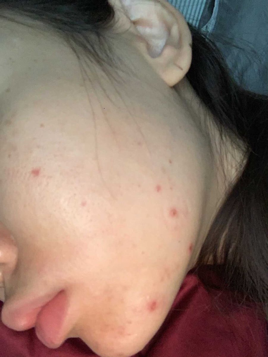 SkinliciousB's tweet photo. พีคสุดๆ เซรั่มแต้มสิว สมุนไพร สิวอุดตัน สิวอักเสบ สิวอะไีร สิวแห้งยุบไวมาก แบบไม่ทิ้งรอยกวนใจ แถมลดการเกิดสิวซ้ำๆลงด้วย  #skinlicious #เซรั่มแต้มสิวแบบเย็น https://t.co/wPbiIgp8Bs