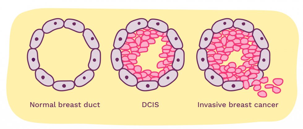 DCIS is an early form of breast cancer. It’s thought that half of DCIS cases pose no harm if left untreated but the other half will turn invasive. Currently, there’s no way of knowing which way a DCIS will go. Our scientists want to understand it better.
 breastcancernow.org/about-us/news-…