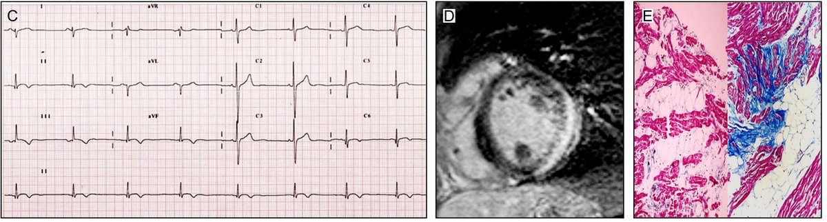 LaredoMikael's tweet photo. Read our research letter in @JACCJournals assessing Left Posterior Fascicular Block as a marker for LV scar and risk of SCD in young people: https://t.co/XRxSj2CpyX

Grateful to Prof. L. Caló and his team @cinzi1988 for the fantastic collaboration !

#EPeeps #cardiotwitter https://t.co/xwpKC3sfBX