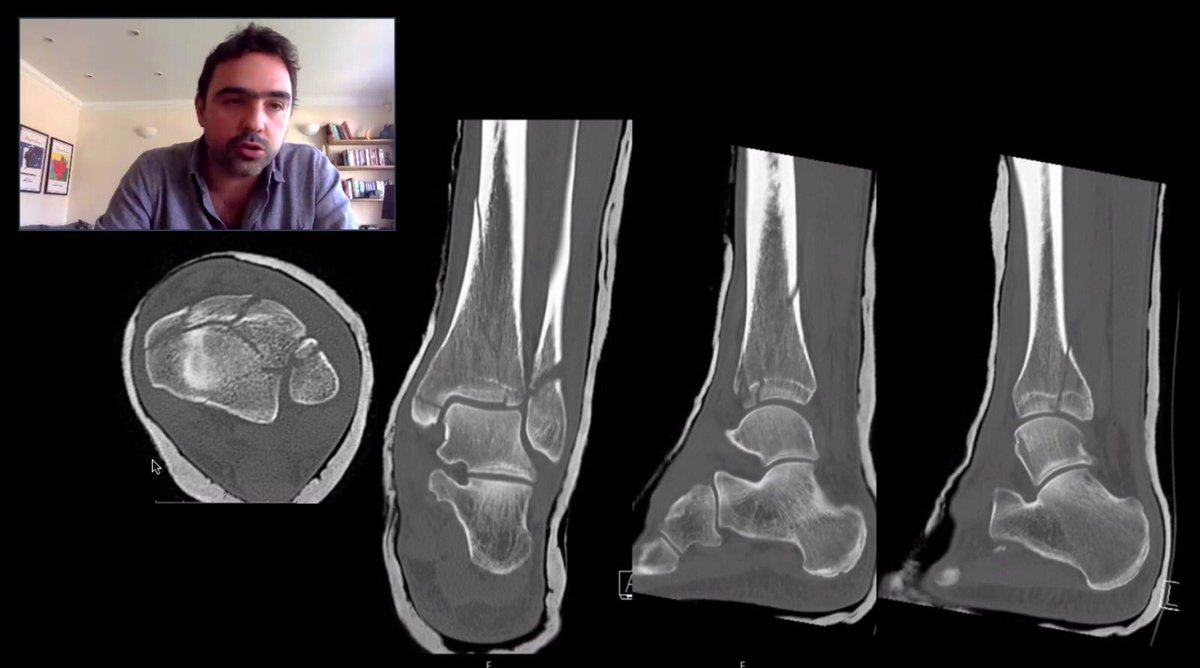 Cambridge Orthopaedics Lower Limb Trauma Course - Mr Alex Vris educating trainees about pilon fractures  <a href="/Alex_Vris/">Alex V</a> <a href="/JaiRawal12/">Jai Rawal</a> <a href="/mikebarrett647/">Mike Barrett</a> <a href="/CambridgeOrthos/">Carrothers Orthopaedics</a> <a href="/JosephAlsousou/">Joseph Alsousou</a> <a href="/CambridgeOrtho1/">@CambridgeOrthopaedics</a> <a href="/Gnomelover1970/">Lee Van Rensburg</a> <a href="/kangsta77/">Niel Kang</a> <a href="/eoeortho/">EoE Ortho</a> <a href="/OrthohubXYZ/">orthohub.xyz</a> @RoyalLondonHosp