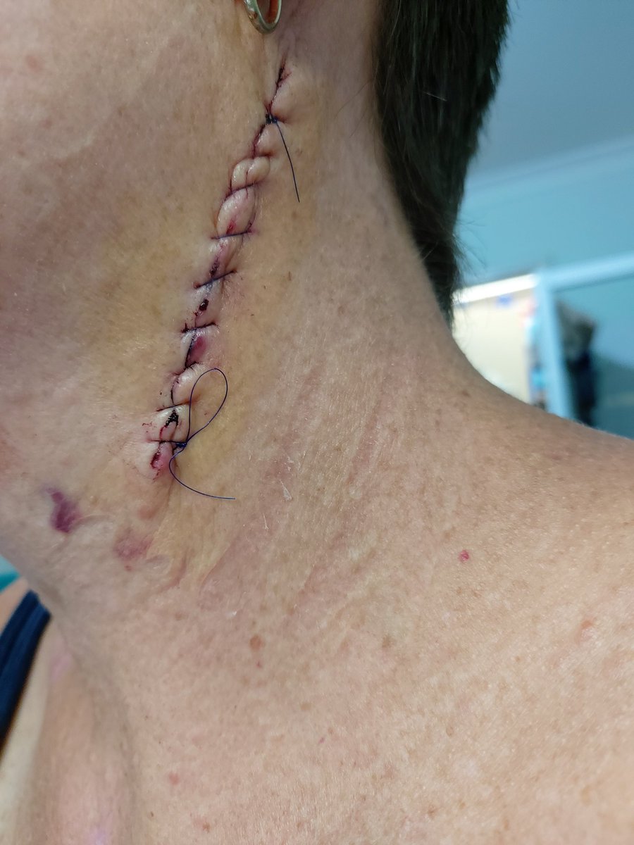 A reminder to always take care out in the sun. #skincancer #melanoma #fuckcancer