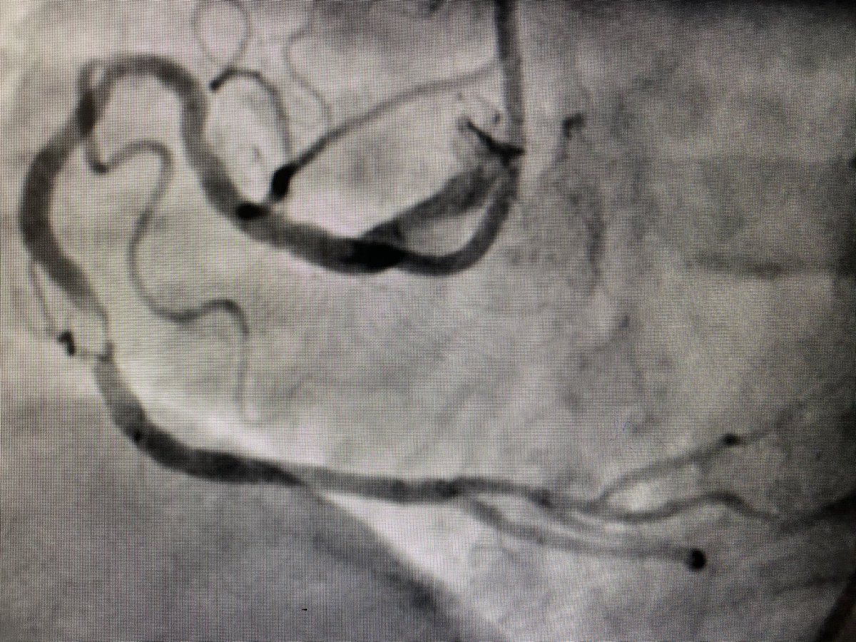 Morning started with this Shepherd's crook RCA PCI. #pcicase #cardiotwitter
