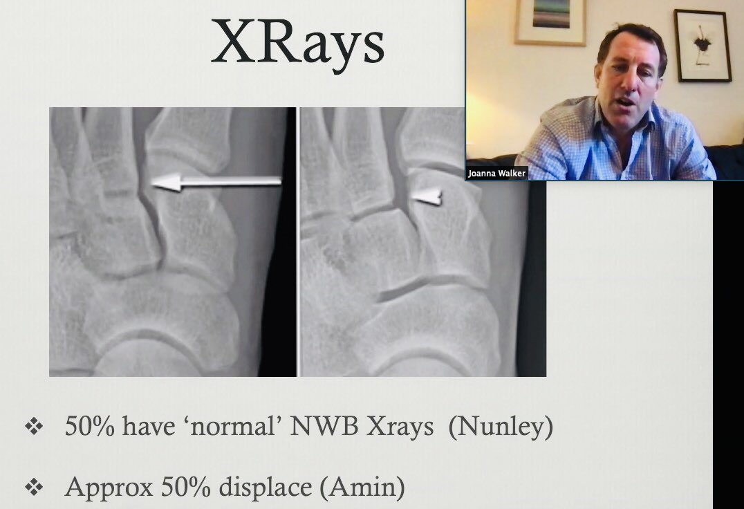 Mr George Smith <a href="/NNUH/">Norfolk and Norwich University Hospitals</a> teaching on Cambridge Orthopaedics Lower Limb Trauma Course <a href="/CambridgeOrtho1/">@CambridgeOrthopaedics</a> <a href="/CUH_NHS/">Cambridge University Hospitals NHS</a> THE LISFRANC INJURY <a href="/mikebarrett647/">Mike Barrett</a> <a href="/JaiRawal12/">Jai Rawal</a> <a href="/Gnomelover1970/">Lee Van Rensburg</a> <a href="/kangsta77/">Niel Kang</a> <a href="/HusseinTaki/">Hussein Taki</a> <a href="/JosephAlsousou/">Joseph Alsousou</a> <a href="/CambridgeOrthos/">Carrothers Orthopaedics</a> <a href="/kumarkhs/">Sunil Kumar</a> <a href="/eoeortho/">EoE Ortho</a> <a href="/Alex_Vris/">Alex V</a>