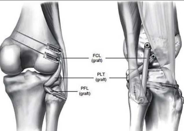 Сшивание связок коленного сустава. Аутопластика пкс коленного сустава. Внутренняя боковая связка колена. Артродез коленного сустава. Растяжение коленной боковой связки.