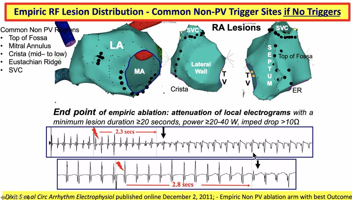 netta_doc's tweet photo. Dr. Marchlinksi's acute endpoints for #AblateAFib - Antral PV isolation + NonPV trigger ablation.
Signal attenutaion is endpoint with empiric ablation when non-PV triggers are unable to be found.
#WAFib2021 https://t.co/1l3S59HWyh