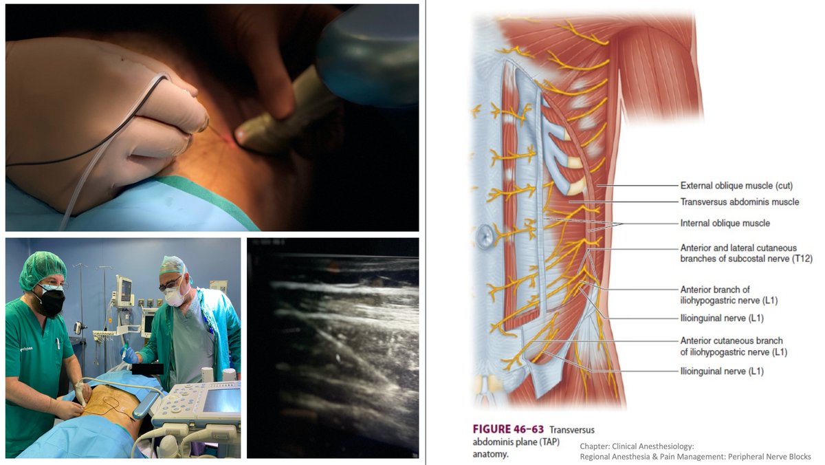 USAnesthesia's tweet image. Ultrasound guided transversus abdominis plane ( TAP)
TAP BLOCK 
Unidad del Dolor 
Hospital @Vithas Madrid La Milagrosa, Madrid 
#tapblock #abdominalpain #madrid #dolor #doloragudo 
#dolorcronico #anestesia #painmanagement
