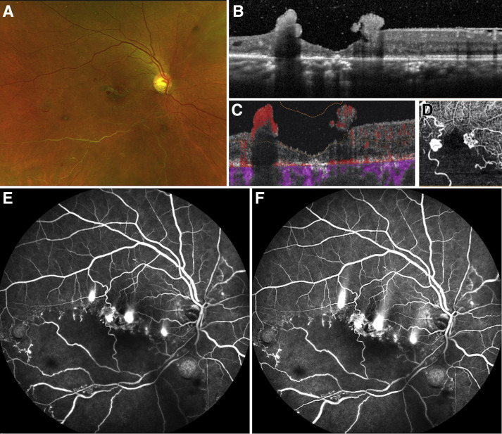 AAOjournal's tweet photo. 57 yo hypertensive woman with sudden diminution of vision in right eye for 3 months was diagnosed with inferotemporal branch retinal vein occlusion with neovascularization. Fluorescein angiography revealed smokestack pattern of leak in the macular region https://t.co/huQLxGjekX https://t.co/u8zIaUFD72