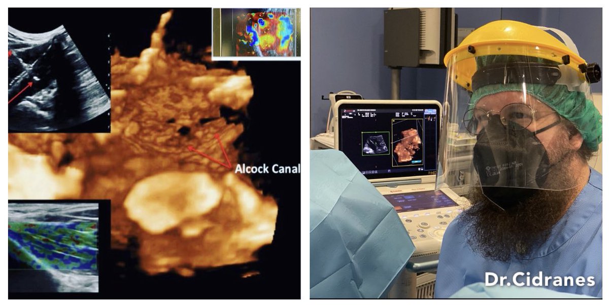 USAnesthesia's tweet image. Pudendal Nerve Entrapment 
Cat Sign- Alcock Hydrodissection 
Unidad del Dolor 
Hospital @vithas Madrid La Milagrosa, #chamberi 
#pelvicfloor #advancedultrasound #painmanagement #dolor #neuralgiadelpudendo #sindromedorosodesuelopelvico #madrid #pudendalemtrapmen #3d4d