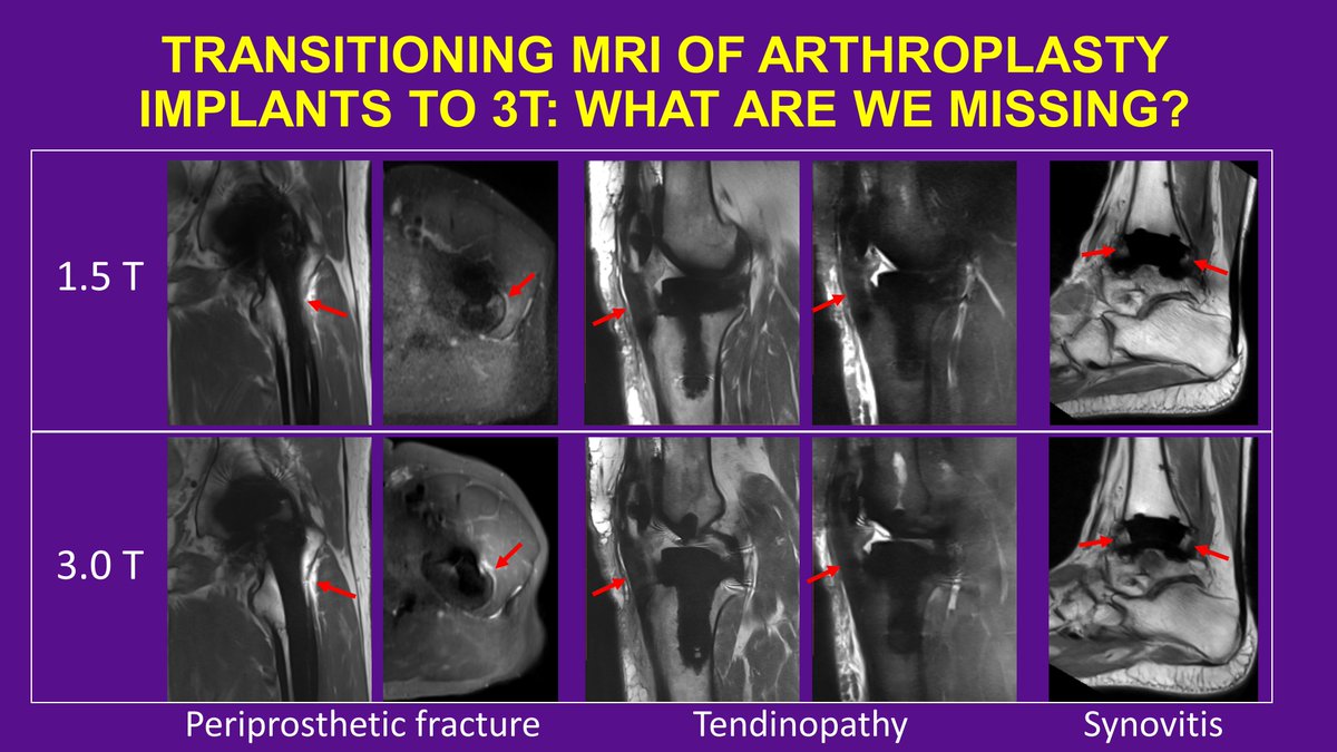 UPCOMING SESSION HIGHLIGHT: 'Transitioning MRI of Arthroplasty Implants to 3T: What Are We Missing?' by Dr. Iman Khodarahmi of @NYUImaging. During the 'Technologies and Techniques I' session Sat, March 13 at 1:30 PM. Eligible Registration: skeletalrad.org/ssr-2021-virtu… #SSR2021