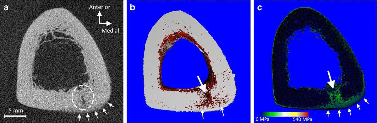 Stuart Warden, PT, PhD, FACSM, FASBMR (@stuartjwarden) on Twitter photo New contribution on BSIs/stress fractures with legendary <a href="/rwilly2003/">Rich Willy</a> and <a href="/edwardswb/">Brent Edwards</a>. Sorry could not afford $3,800 open access fee, but happy to share if you contact...link.springer.com/article/10.100… New contribution on BSIs/stress fractures with legendary <a href="/rwilly2003/">Rich Willy</a> and <a href="/edwardswb/">Brent Edwards</a>. Sorry could not afford $3,800 open access fee, but happy to share if you contact...link.springer.com/article/10.100…