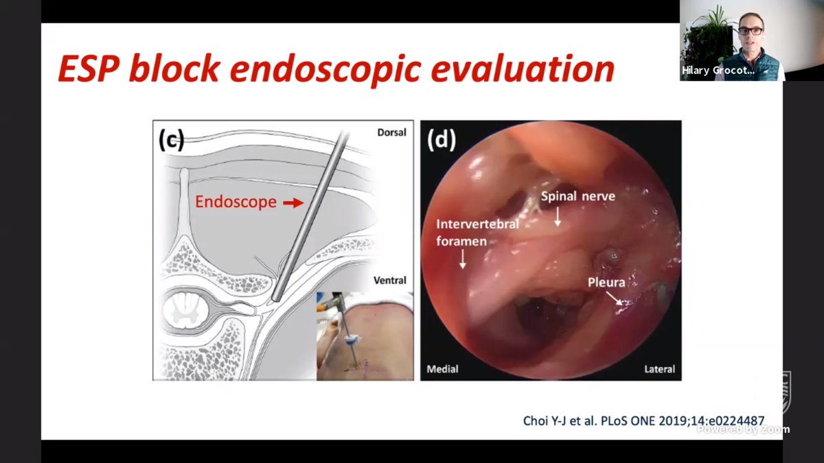 ChrisPrabhakar's tweet image. Dr. Hilary Grocott: endoscopic cadaveric studies suggest volume important to get #ESPblock to #paravertebral space. Of importance, particularly for catheters.  @WhistlerAnesth #WAS2021