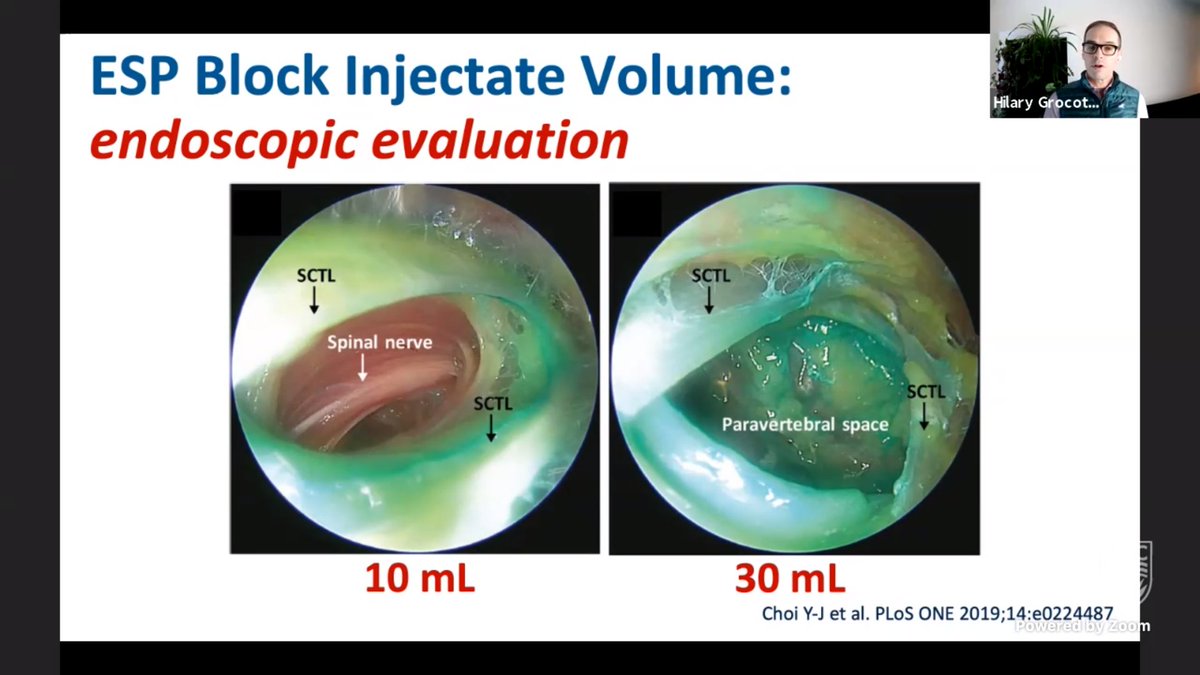 ChrisPrabhakar's tweet image. Dr. Hilary Grocott: endoscopic cadaveric studies suggest volume important to get #ESPblock to #paravertebral space. Of importance, particularly for catheters.  @WhistlerAnesth #WAS2021