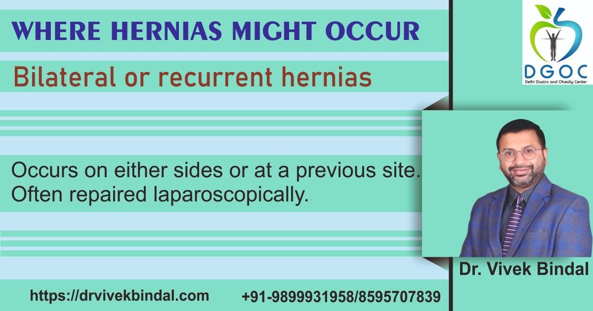 drvivekbindal's tweet photo. #Where #hernia might occur
#Bilateral or #recurrent Hernia
Occurs at either sides or previous site, often repaired #laparoscopically
for detail contact - @drvivekbindal - https://t.co/TkqdRUaYtJ
#herniainmen #herniainwomen #herniatreatment #medical #FemoralHernia #inguinalhernia https://t.co/z8zE63wj1i