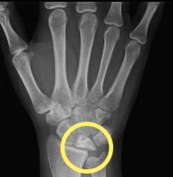anilbhatortho's tweet photo. #Kienbock’s disease :Lunate avascular necrosis due to interplay of repetitive microtrauma, anatomical variances,&/or vascular abnormalities
19 year old patient without history of trauma showing stage 3
disease .patient’s normal side X-ray also shows gross negative ulnar variance https://t.co/IKs5NZBxFw