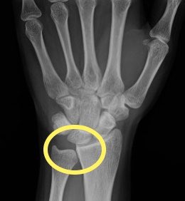 anilbhatortho's tweet photo. #Kienbock’s disease :Lunate avascular necrosis due to interplay of repetitive microtrauma, anatomical variances,&/or vascular abnormalities
19 year old patient without history of trauma showing stage 3
disease .patient’s normal side X-ray also shows gross negative ulnar variance https://t.co/IKs5NZBxFw