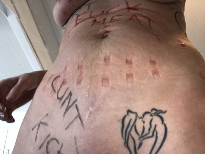 The result of 45 mins wearing clothespins... that was freaking painful I can tell you... session combined<a href="/tag/bdsm"class="tags"><span>#bdsm</span></a><a href="/tag/painslut"class="tags"><span>#painslut</span></a><a href="/tag/onlyfans"class="tags"><span>#onlyfans</span></a>