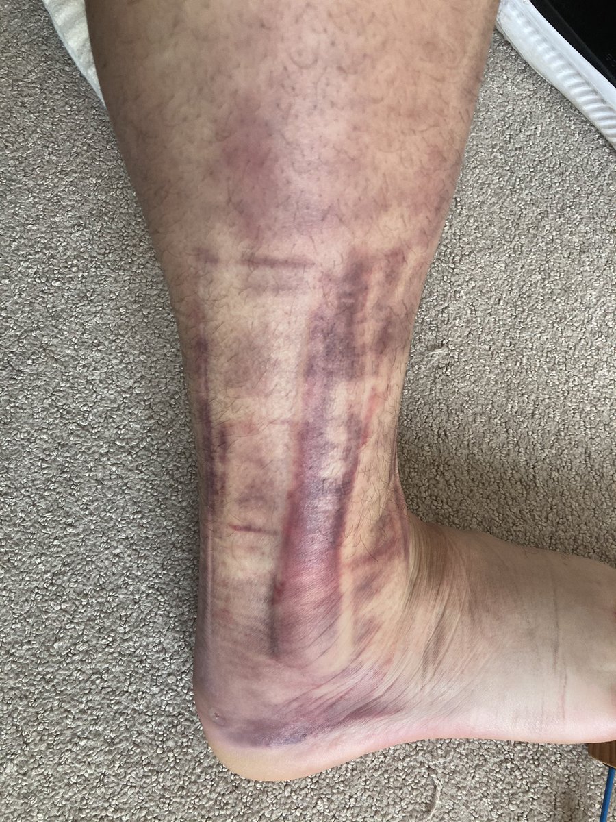 HeatCheckTime's tweet photo. Even w/ 🏀 season shortened this year I wasn’t able to avoid the annual ankle sprain 🤦‍♂️🤷🏼‍♂️ still not going to hang them up though https://t.co/9CkGUVwTjy