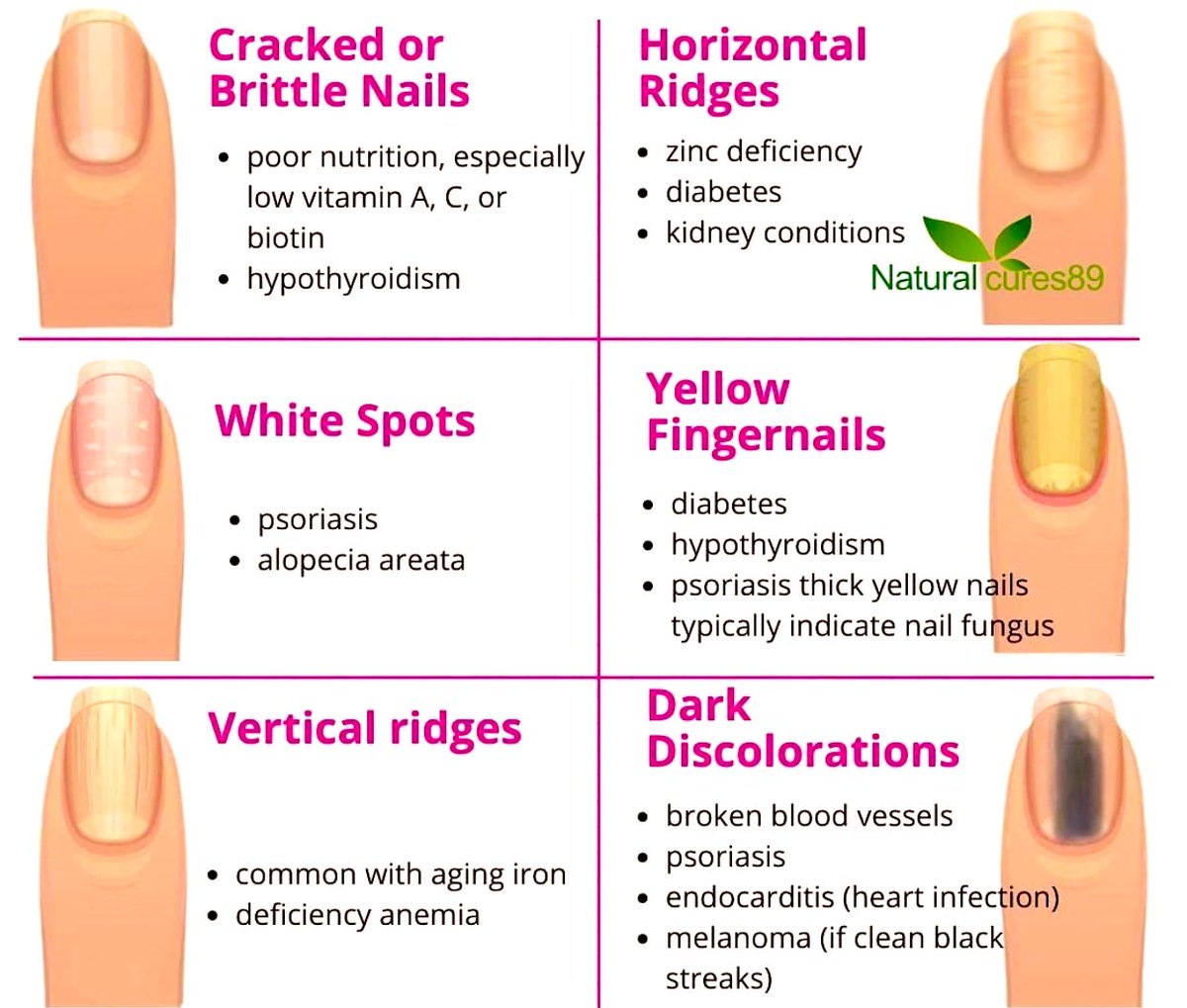 Are You Seeing Holes & Dents In Nails? Read This!