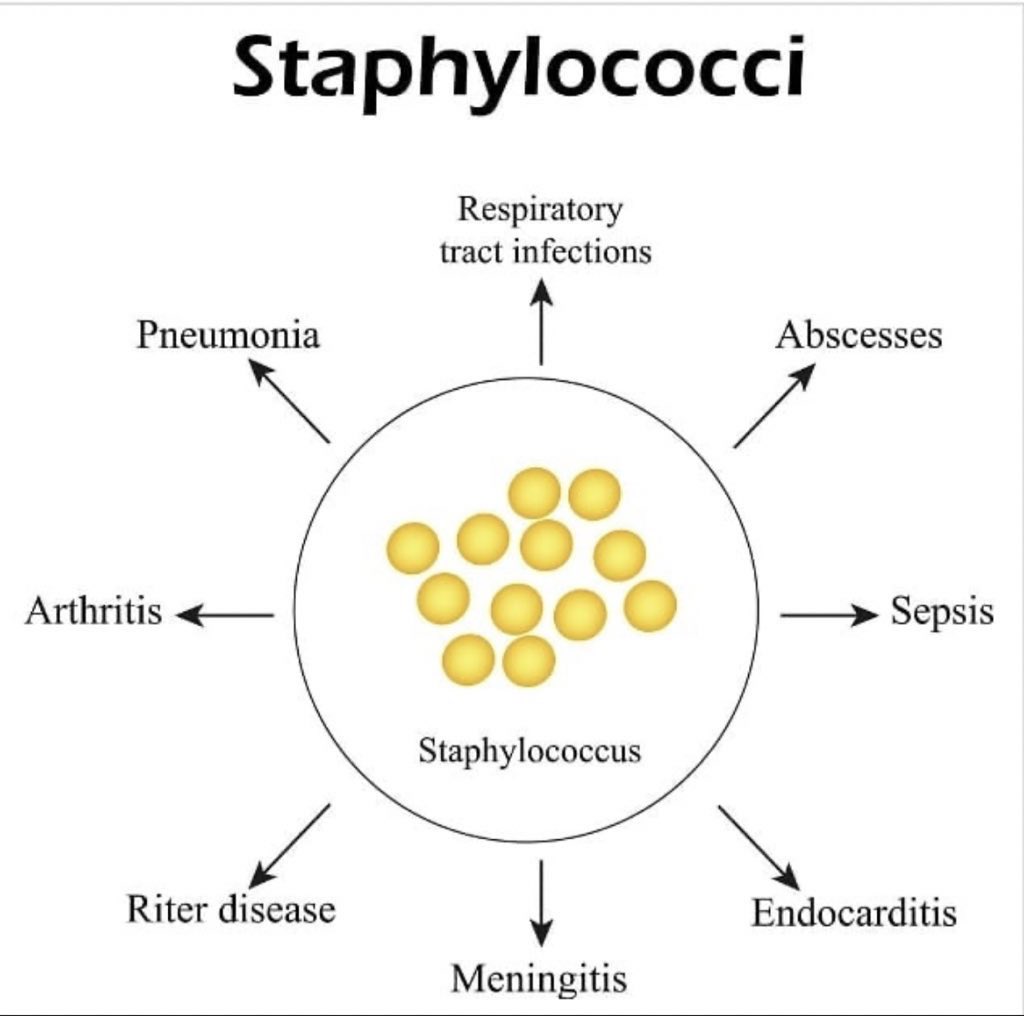 Ghazi2014's tweet photo. Staphylococci🔬

صورة توضح الامراض اللي تسببها 🦠
احفظها عندك👍🏼 https://t.co/gp6kdpwsgk
