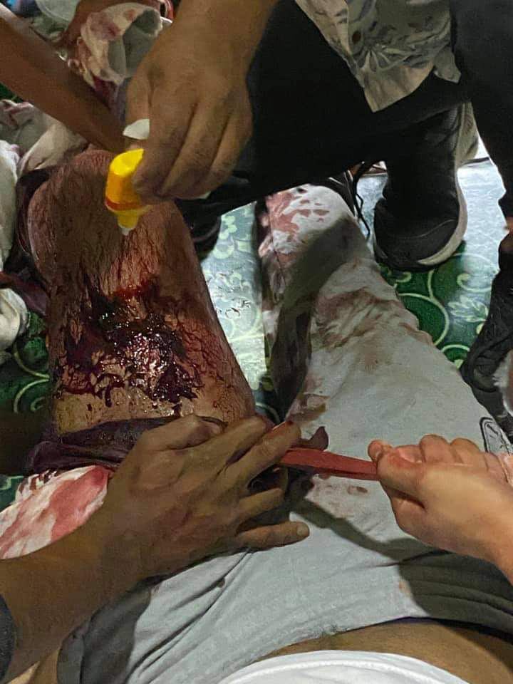 TW // Gunshot Wound
TW // Blood
Injured protester from Hledan strike

#WhatsHappeningInMyanmar
#MilkTeaAllianceMyanmar