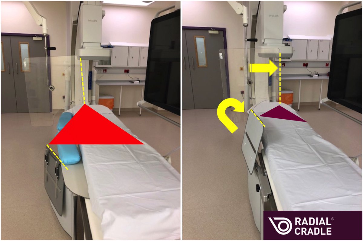 Stephen Hoole (@hoole_stephen) on Twitter photo Reduce your radial radiation exposure by 70% simply by abandoning the arm board! Get the Perspex lead screen medial and lead underskirt deployed to decrease your scatter area with the help of <a href="/radialcradle/">@radialcradle</a> #RadialFirst #cardiotwitter
radialcradle.com/radiation Reduce your radial radiation exposure by 70% simply by abandoning the arm board! Get the Perspex lead screen medial and lead underskirt deployed to decrease your scatter area with the help of <a href="/radialcradle/">@radialcradle</a> #RadialFirst #cardiotwitter
radialcradle.com/radiation